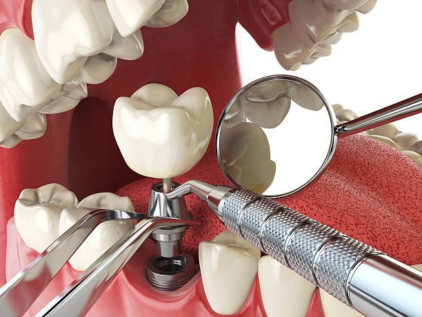 Best Emergency Wisdom Teeth Removal in Nashua, NH